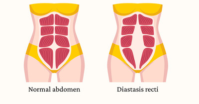 Anatomical drawing of normal abdomen next to one with diastasis recti.